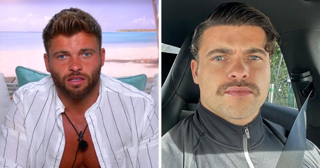 Love Island star Jake Cornish before and after a hair transplant