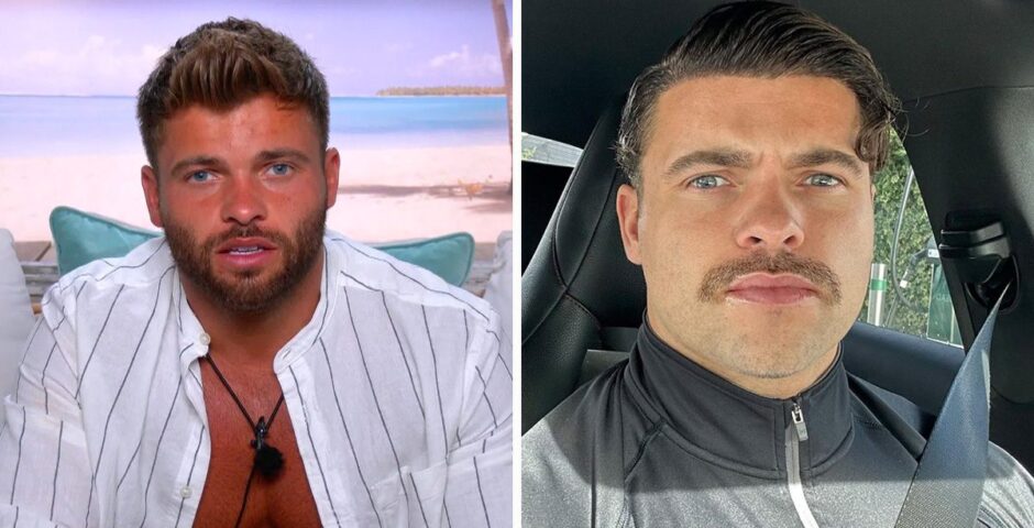 Love Island star Jake Cornish before and after a hair transplant