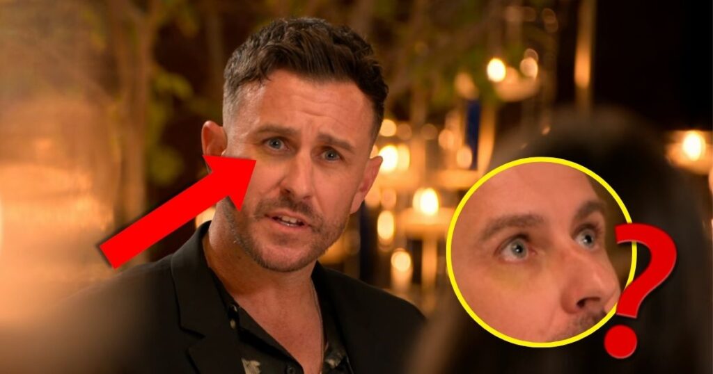 nick the ultimatum black eye