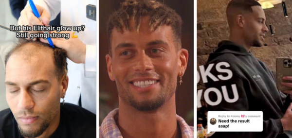 Love Island Ouzy hair transplant