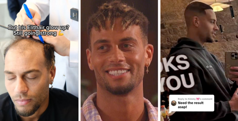 Love Island Ouzy hair transplant