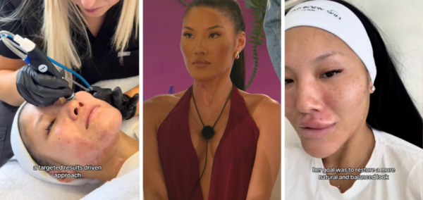 Sophie Lee had cosmetic work for Love Island 2025