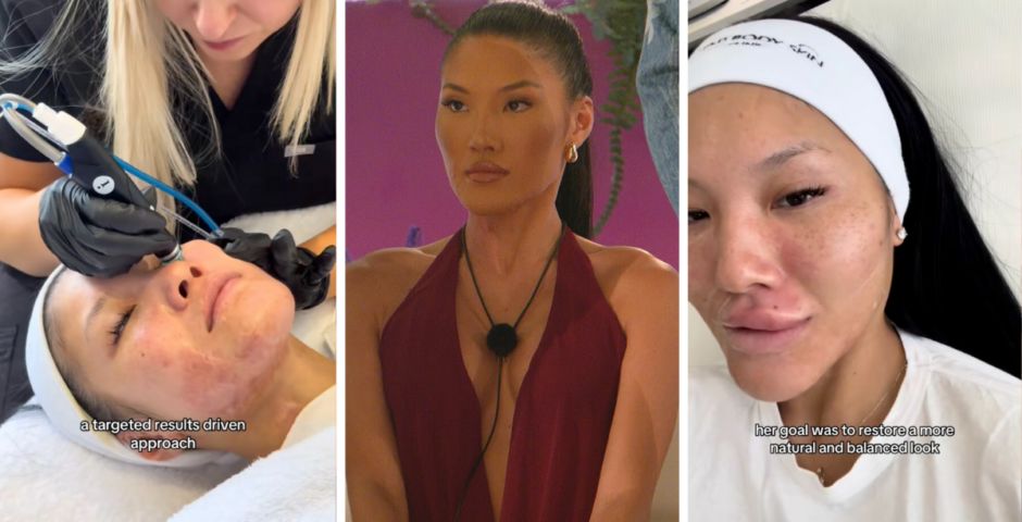 Sophie Lee had cosmetic work for Love Island 2025