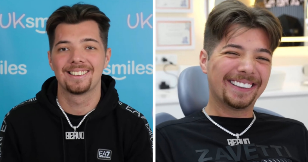 Beavo teeth before and after