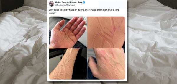 lines on your skin during a nap