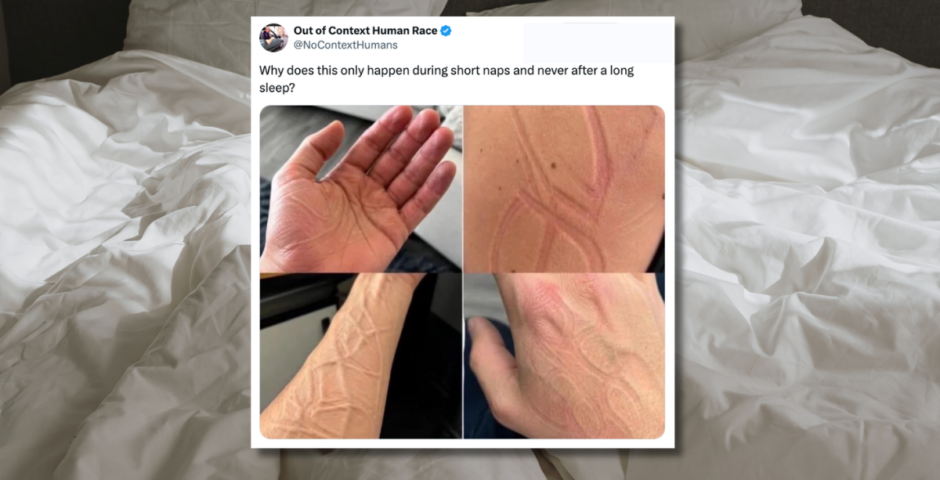 lines on your skin during a nap