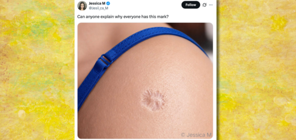 why people have the same vaccine scar