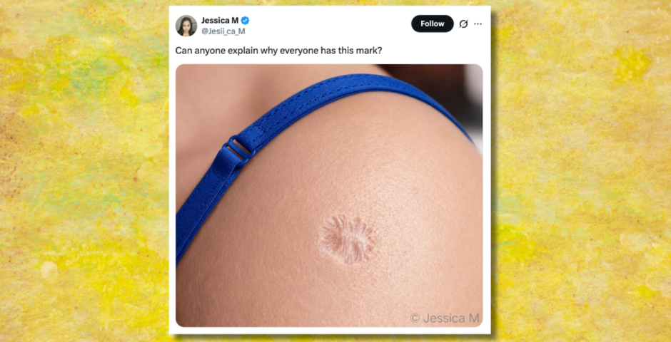 why people have the same vaccine scar