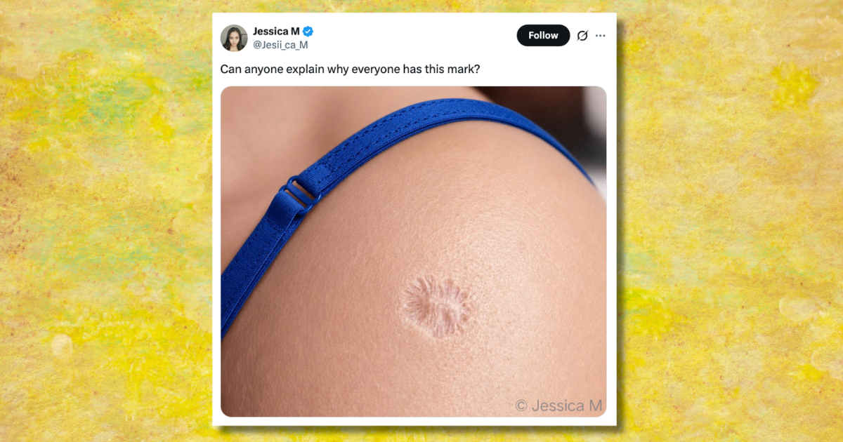 Wait, does everyone have this very same scar? People are only just realising where it comes from