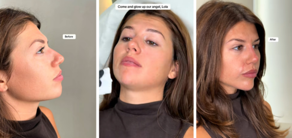 Lola getting work done after Love Island