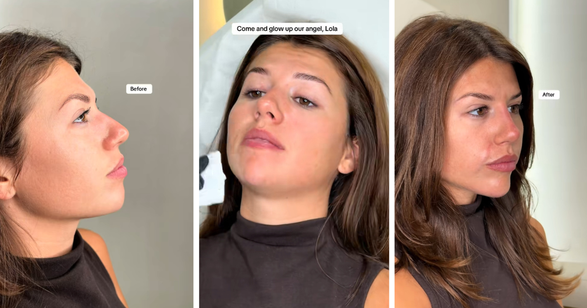 Lola just dropped £1,200 on a whole range of cosmetic procedures after Love Island