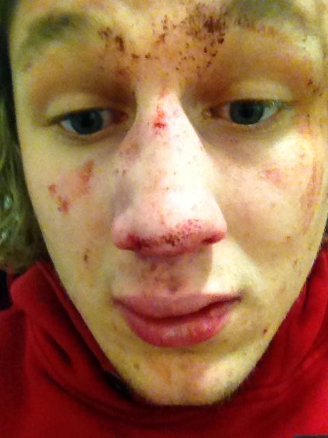 ...and his team-mate Jack O'Driscoll. His nose doesn't usually look like that