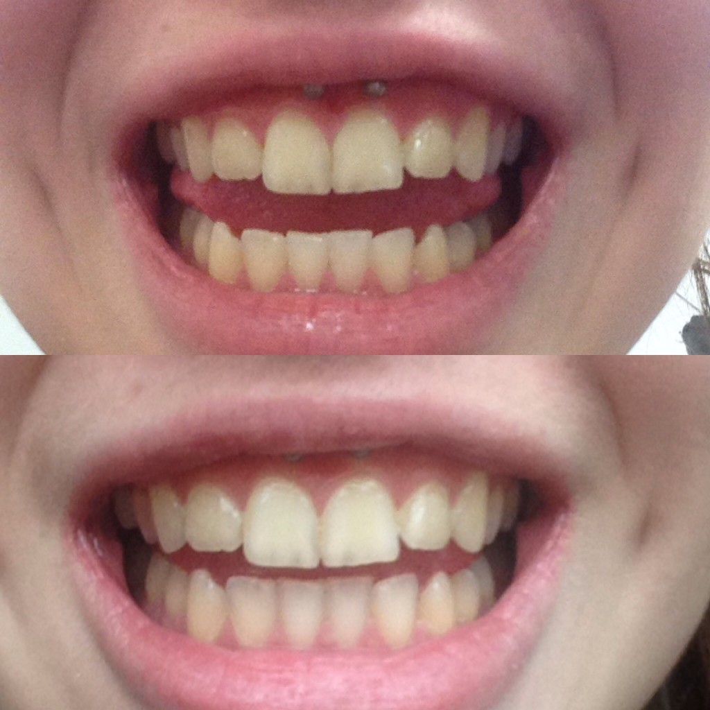Top = before Bottom= after 