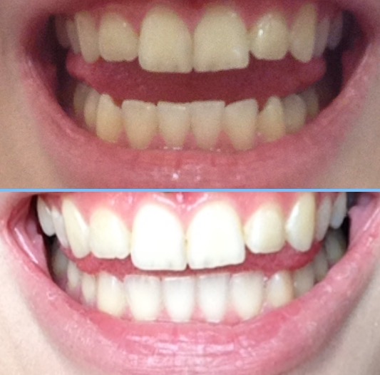 Top = before teeth whitening, Bottom = after three months 