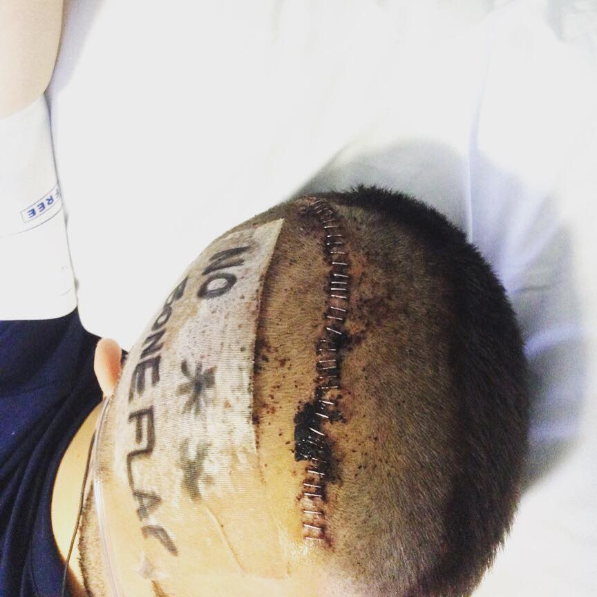 I had a titanium plate fitted in my skull to replace the chunk which was removed