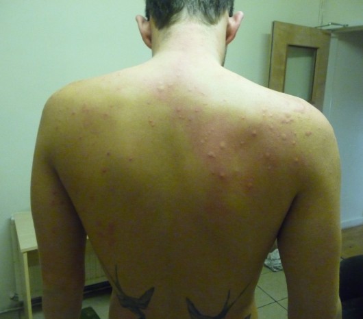 What happens when you let the bedbugs bite