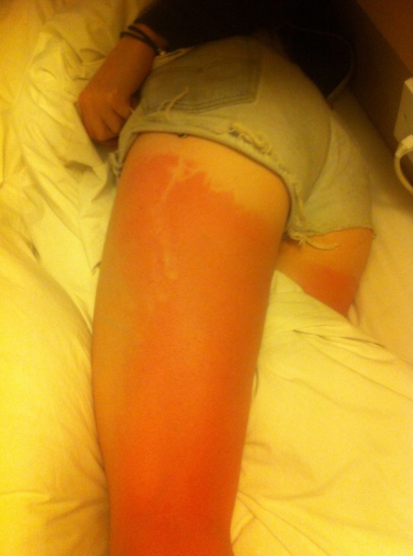 sunburn