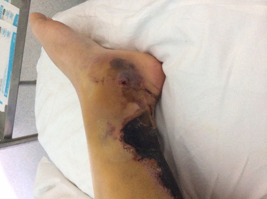 injury 2