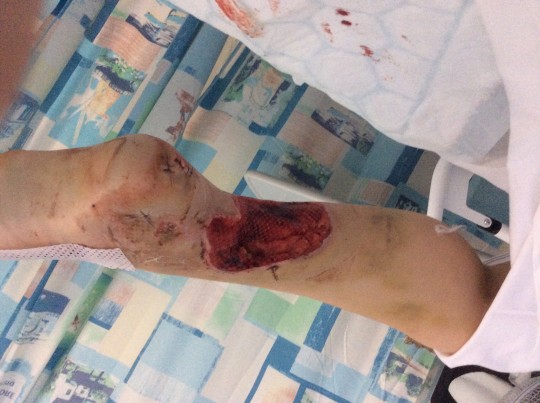 injury 3