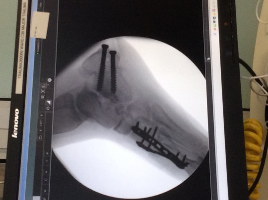 screws in leg