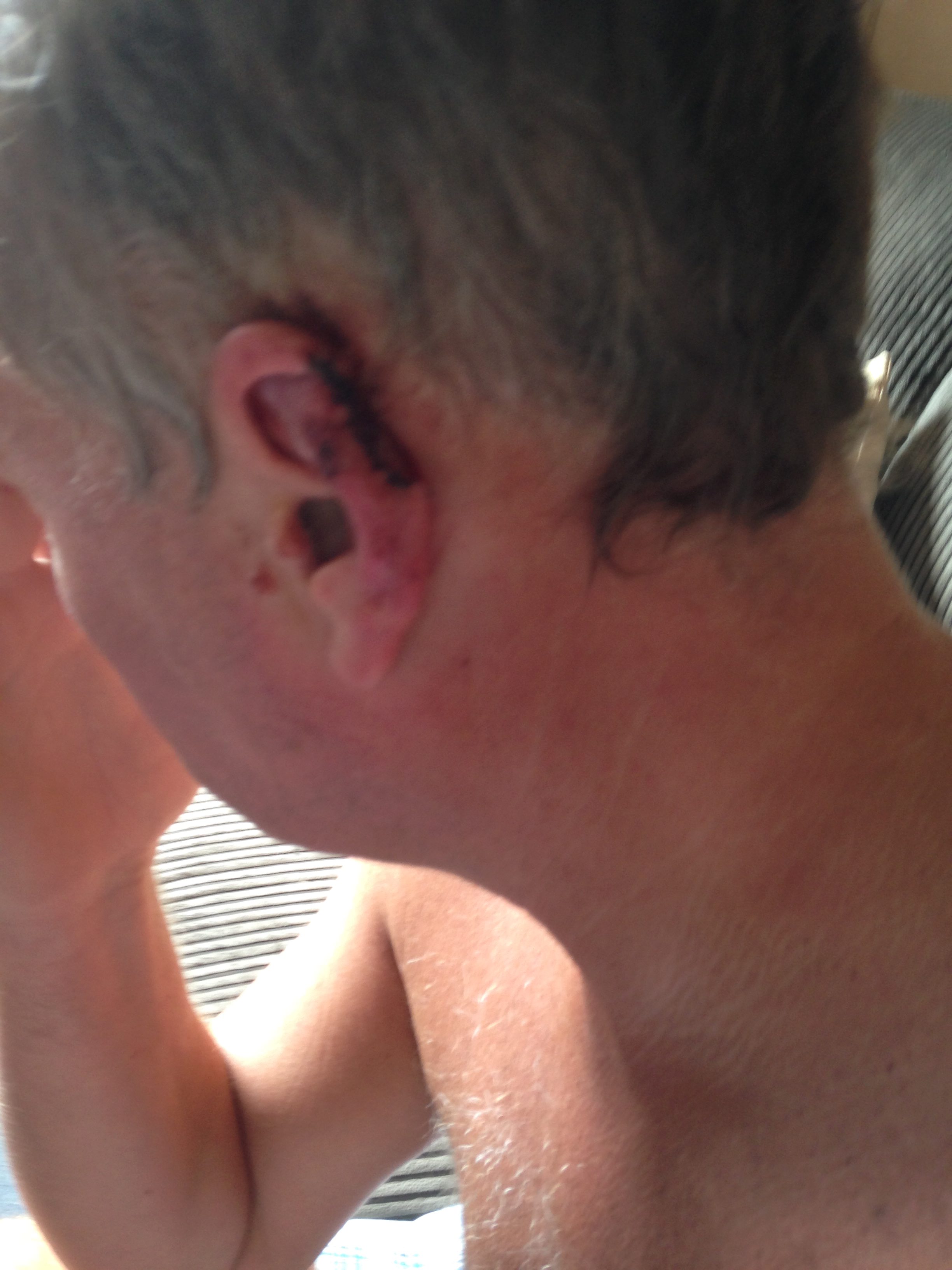 NTI_EAR_BITE_06