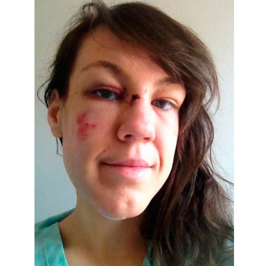 Teddy Hall student Jeanne Marie bravely posted a photo of her images to Facebook to raise awareness of the attack
