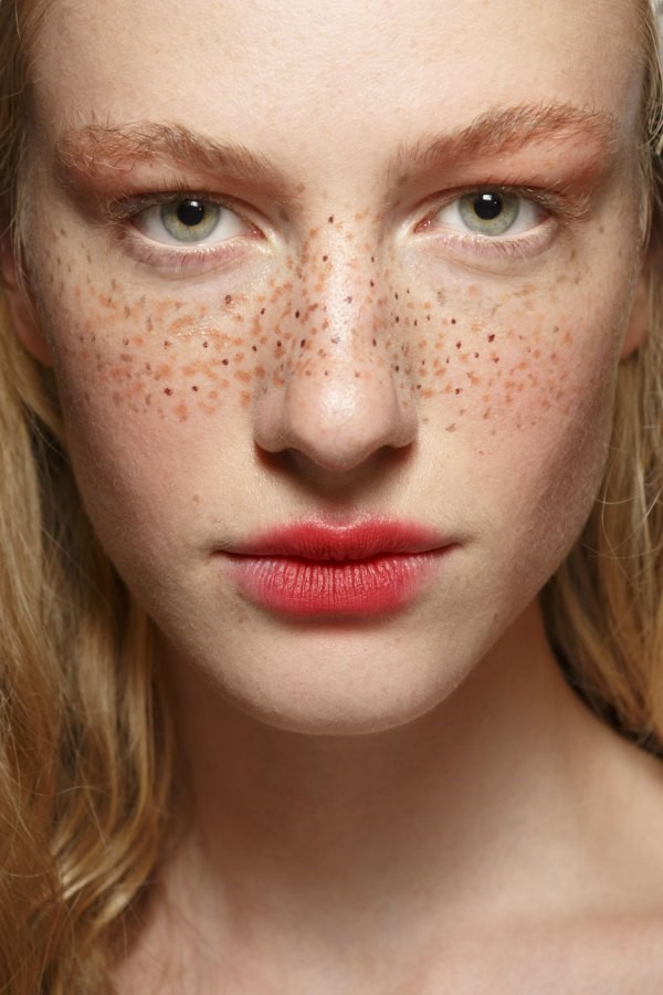 freckles