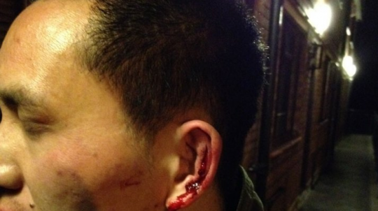 Mr Li's ear was severely maimed by the attackers