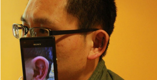 Mr Li's damaged ear