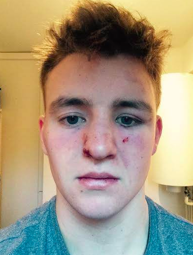 Elliot thought they had broken his nose