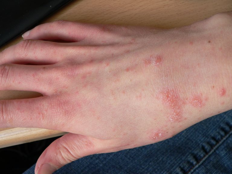 The symptoms can lead to itching and irritation