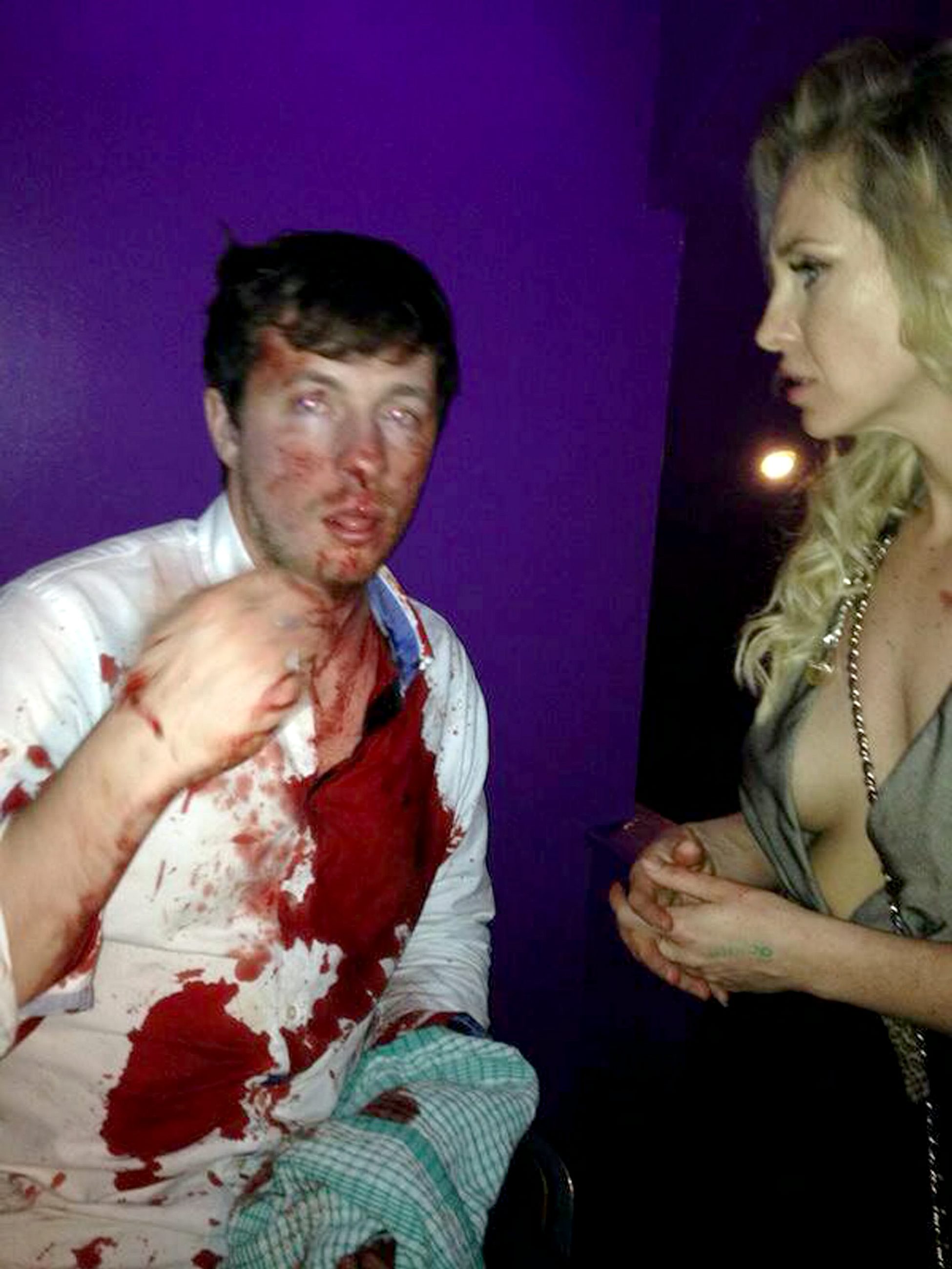 Harry Gibson Was Left With Blood Pouring Out Of His Nose