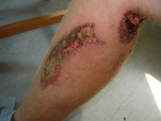 infection
