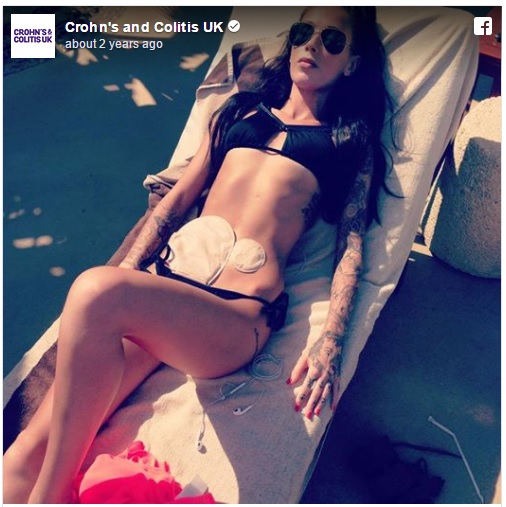 bethany-townsend-stoma-photo