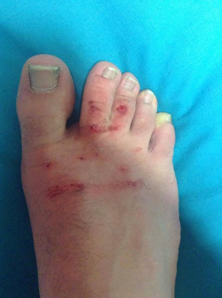 broken foot lewis