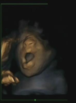 Fetus yawn