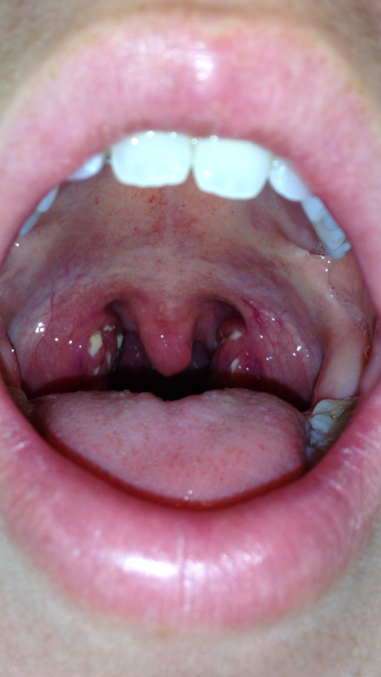 One minor symptom of hepatitis