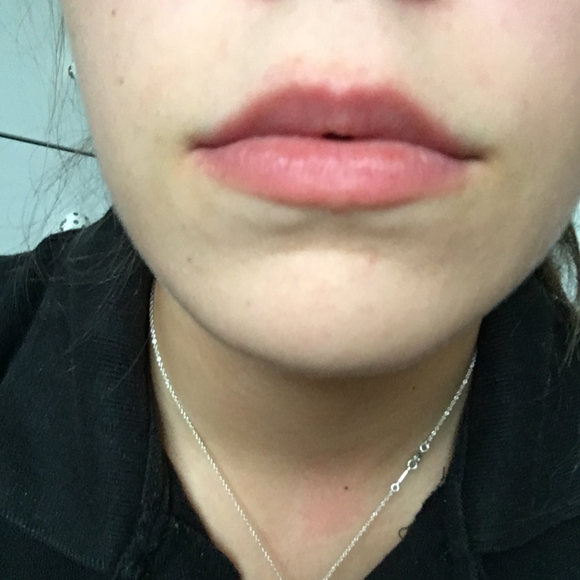 Megs plump pout after a lot of pain.