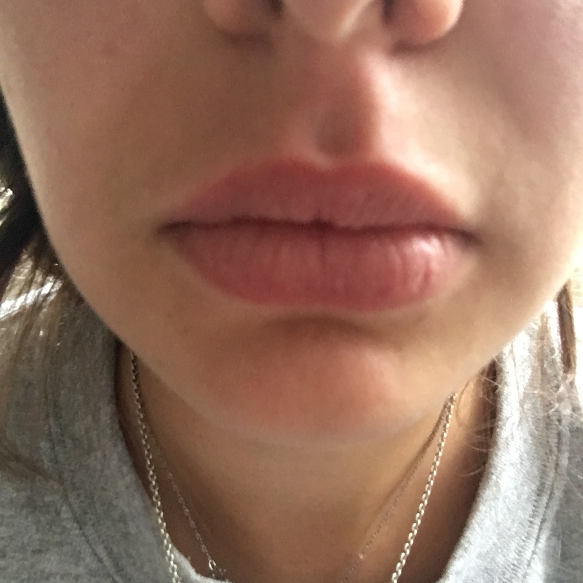 My lips don't look any different they just hurt.