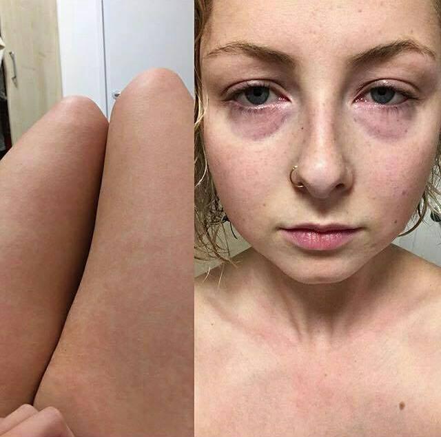 During a flare-up at uni, with swollen eyes and a rash on my legs
