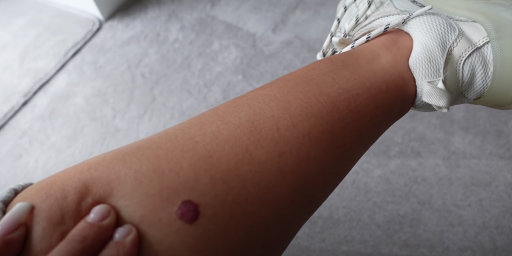 Molly-Mae, Molly Mae Hague, cancerous, mole, vlog, video, YouTube, Love Island, update, news, doctor, venice