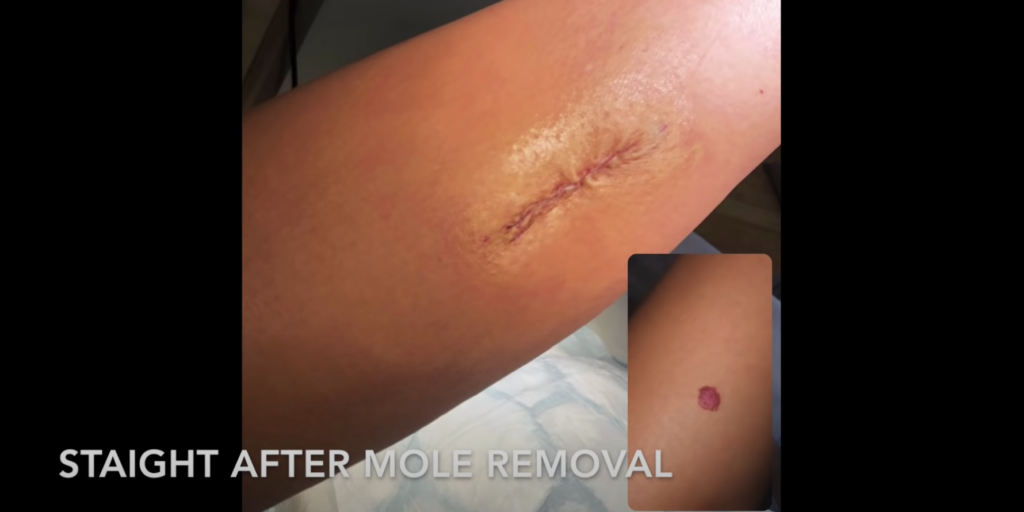 Molly-Mae, Molly Mae Hague, cancerous, mole, vlog, video, YouTube, Love Island, update, news, doctor, venice
