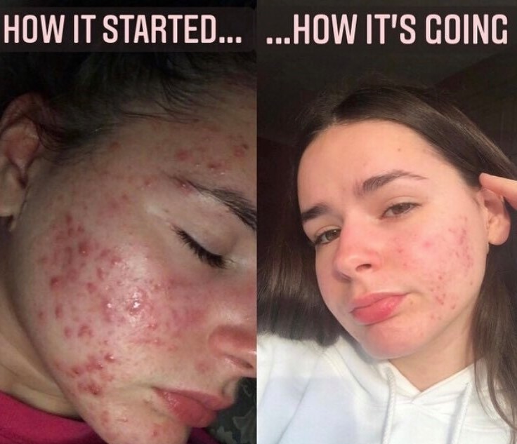 Acne positivity