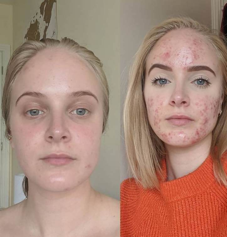 Acne positivity