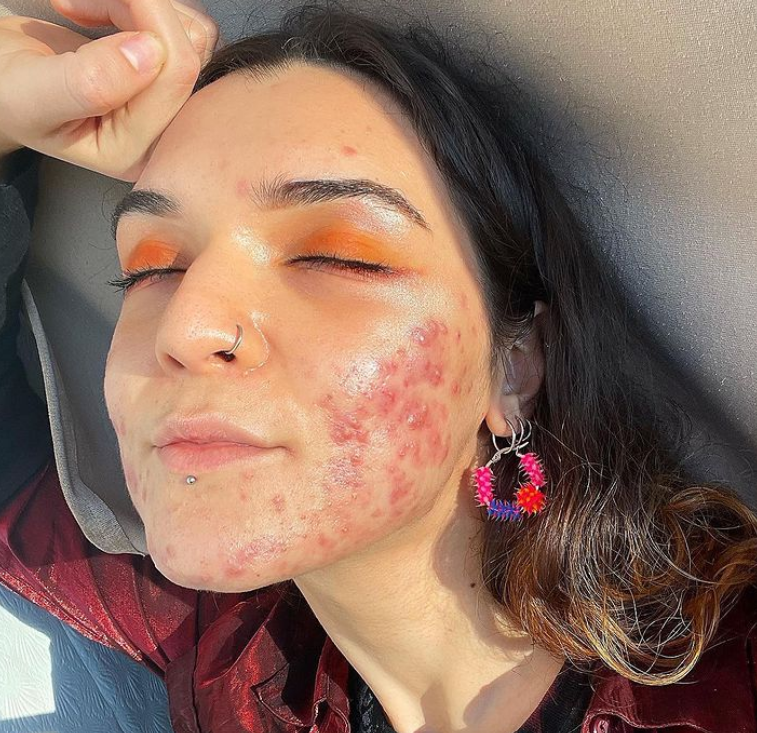Acne positivity