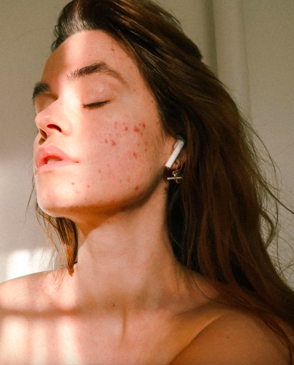 acne, instagram, influencers