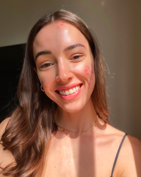 acne, instagram, influencers