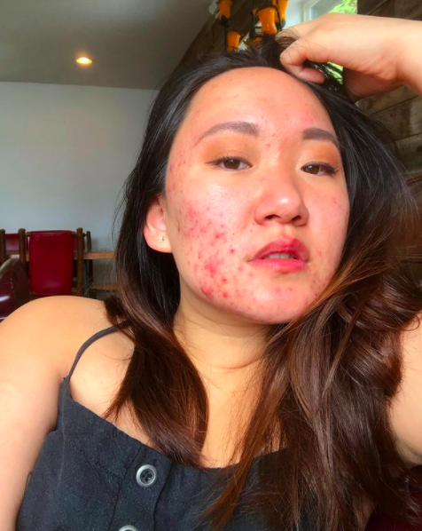 acne, instagram, influencers