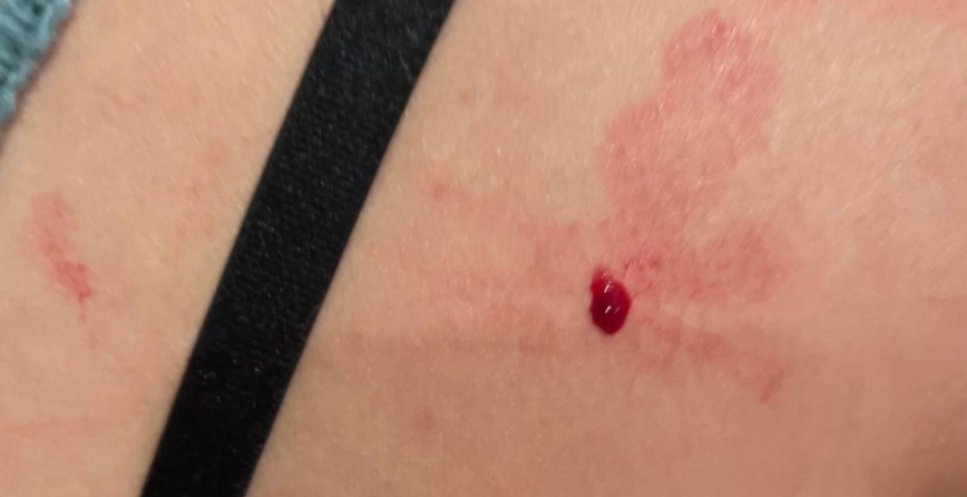 spiking-by-injection