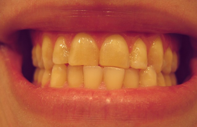 The teeth here have shifted, causing what is known as a deviated midline